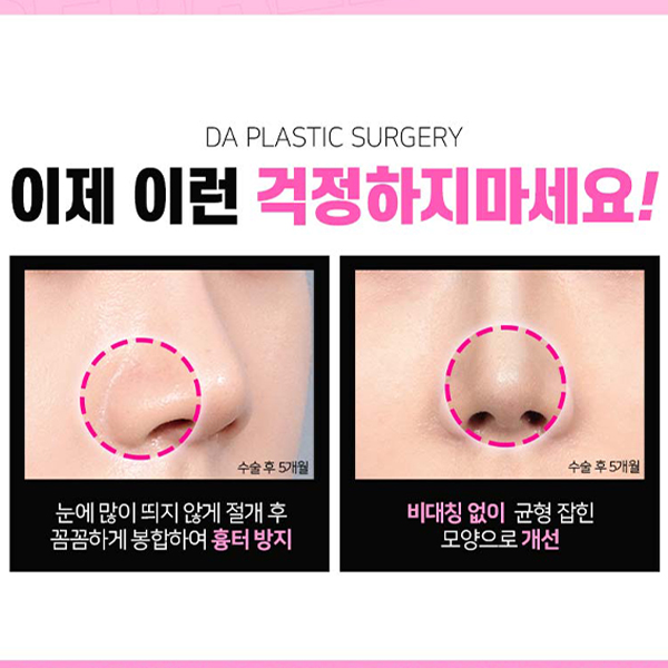 What Matters More Than a Nasal Ala Reduction Review image 7