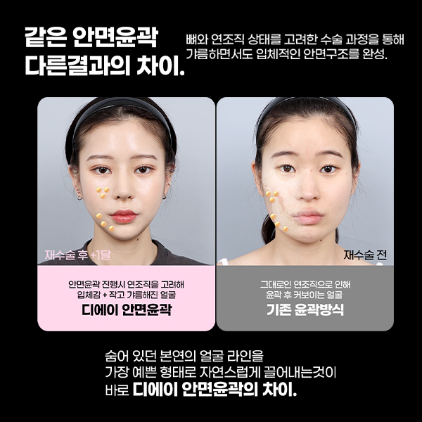 윤곽3종, 많이 깎는다고 예뻐지는 걸까? 관련 이미지 9