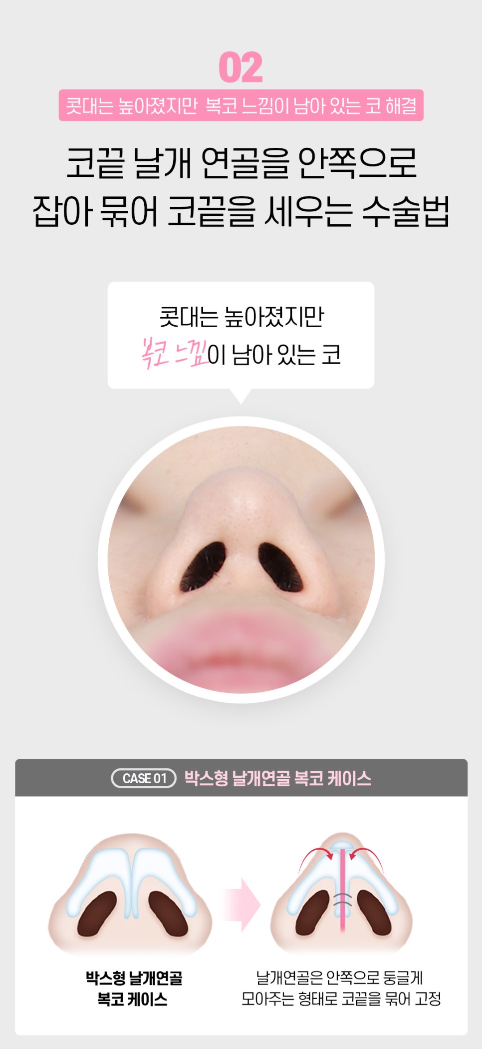 마지막 코재수술 원한다면♡ [DA성형외과] 관련 이미지 6