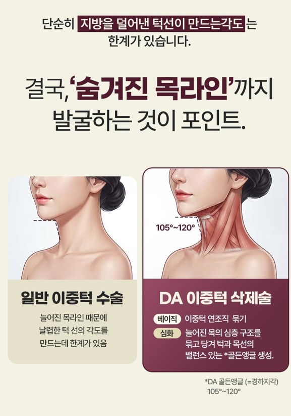 Double Chin Removal Surgery: Essential Information from Effects to Recovery Time image 3