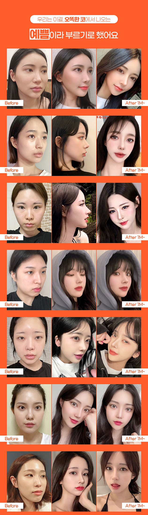 오래도록 오똑하게 자가늑코성형 관련 이미지 5