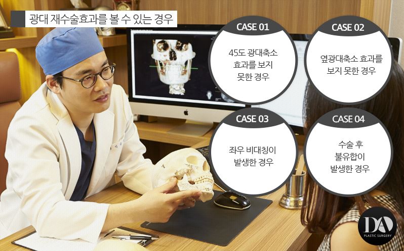안면윤곽 재수술 체크리스트 관련 이미지 9