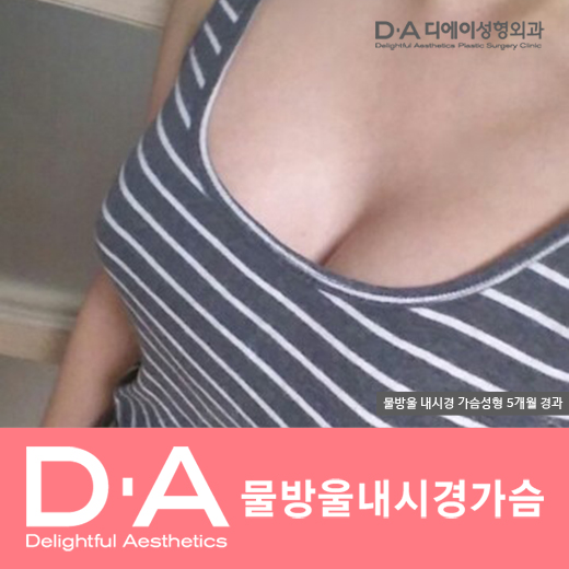 디에이성형외과의 자연스럽고 예쁜 물방울가슴성형 관련 이미지 4