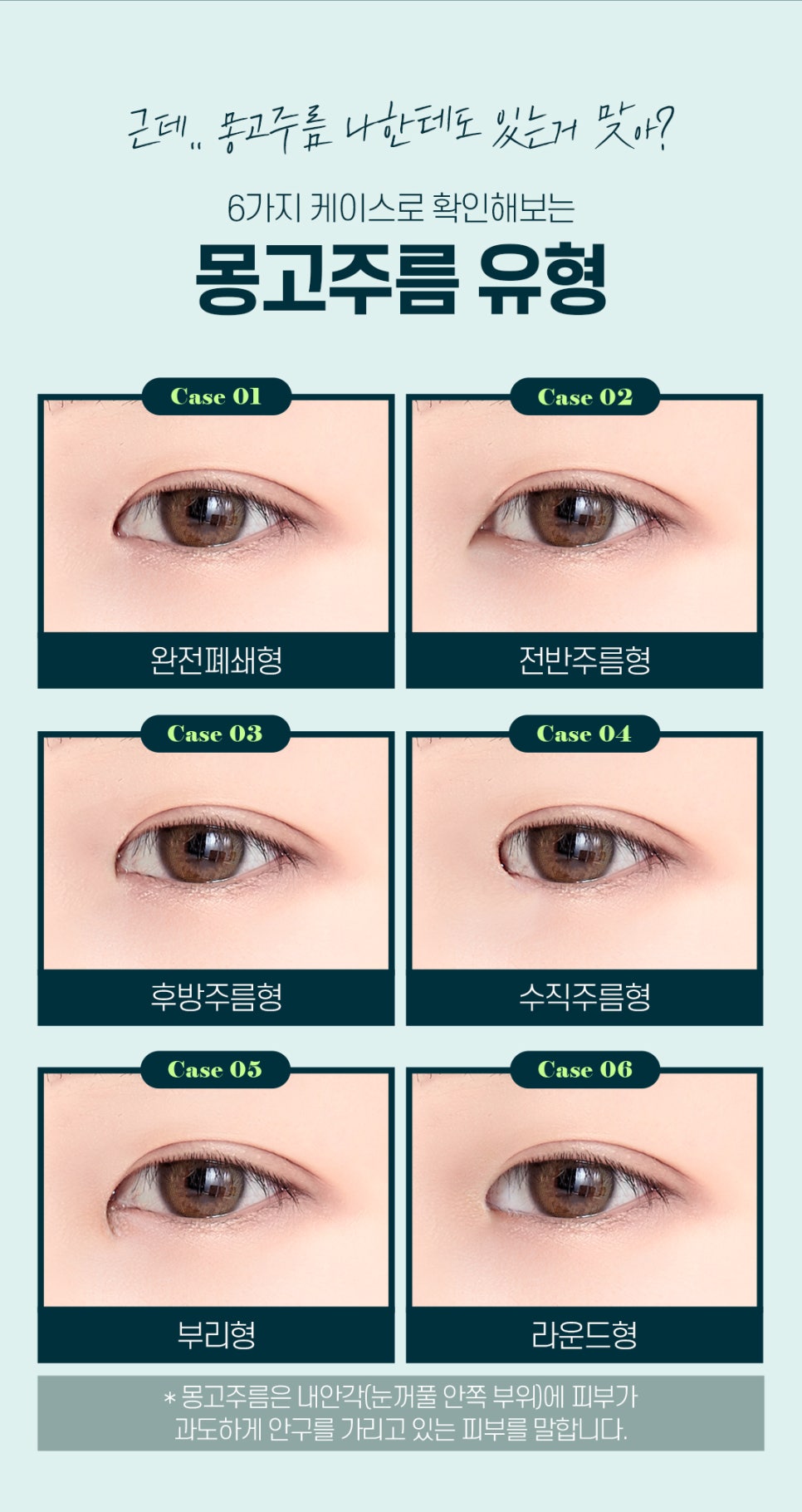 남자앞트임성형 꼼꼼하게 알아보는 법 관련 이미지 4