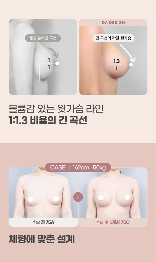 Key Points for Increasing Satisfaction with Bounce Breast Augmentation Using Implants image 6