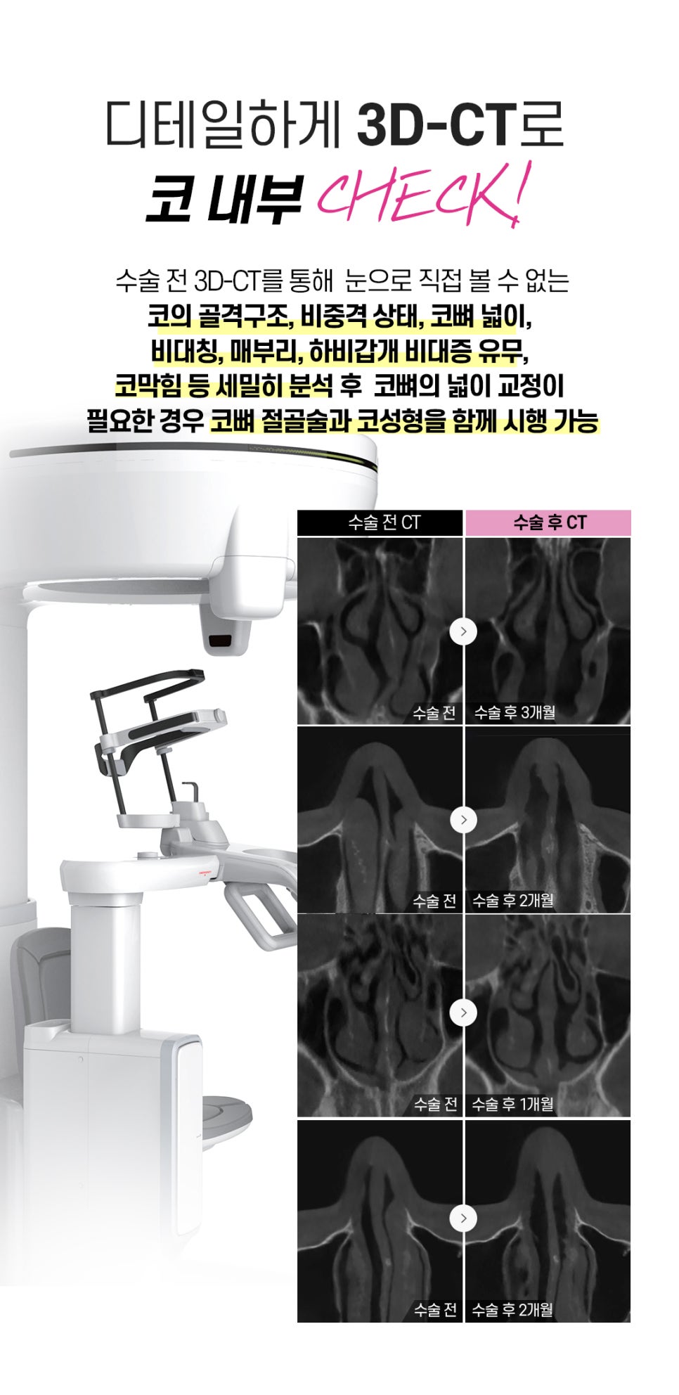 비염미용코성형 안전하고 확실하게 관련 이미지 4