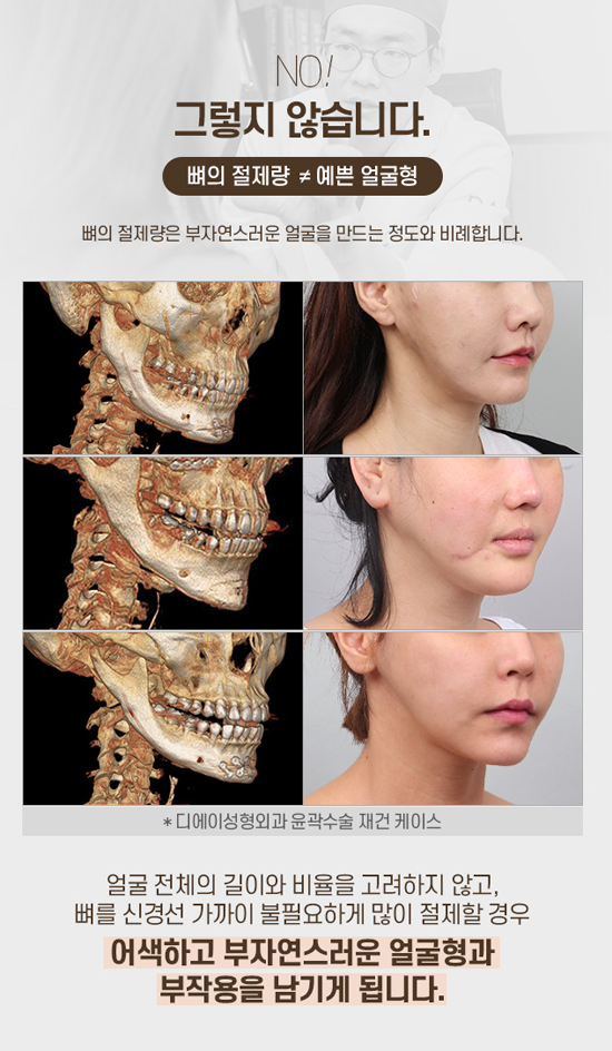 디에이 안면윤곽, 예쁘게 깎고 예쁘게 남기다 관련 이미지 5