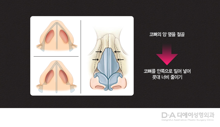 유형별 코성형의 특징과 방법 관련 이미지 18