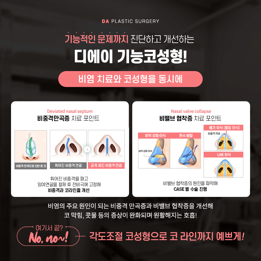 코성형, 개별 맞춤 수술을 위해 알아야 할 것 관련 이미지 7