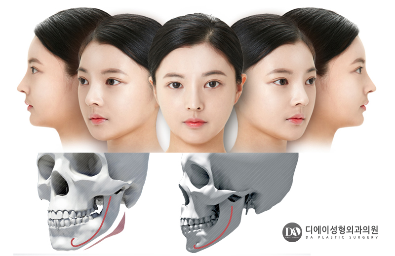 안면윤곽 수술 전 체크사항 관련 이미지 4