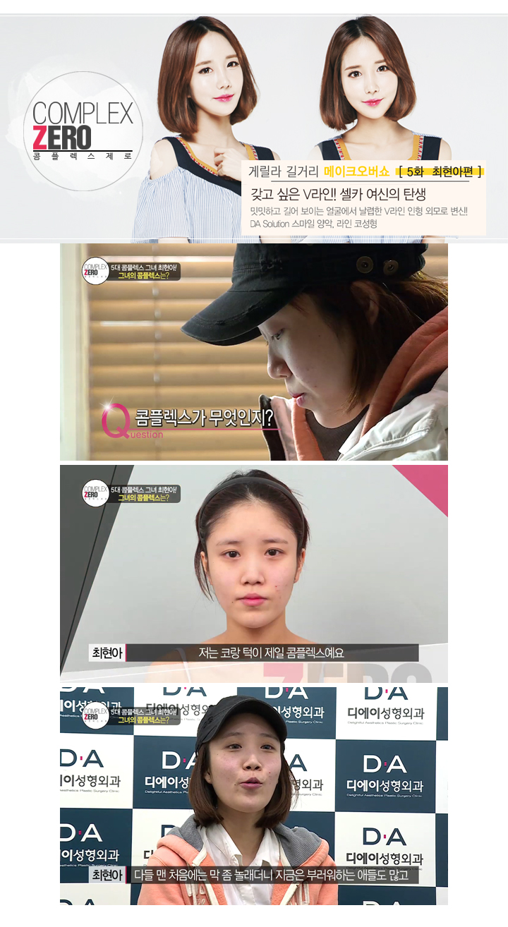 디에이성형외과 콤플렉스제로 5대 제로女 최현아편! 관련 이미지 4