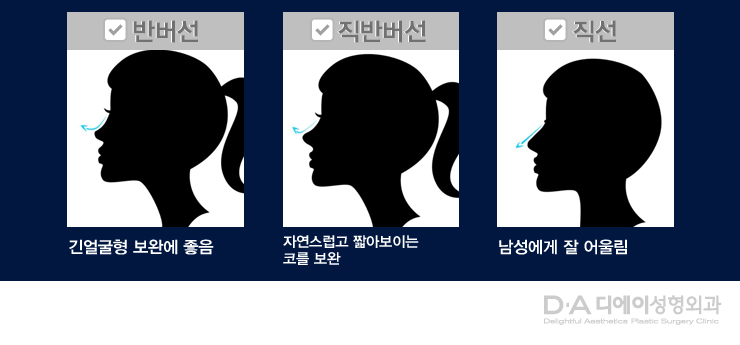 유형별 코성형의 특징과 방법 관련 이미지 3