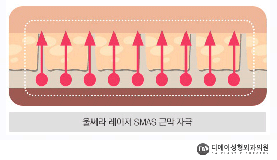 V라인 리프팅 종류 관련 이미지 5