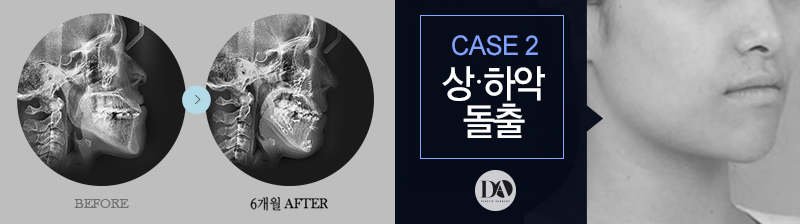 양악수술, 유형별 솔루션 바로 알기 관련 이미지 8