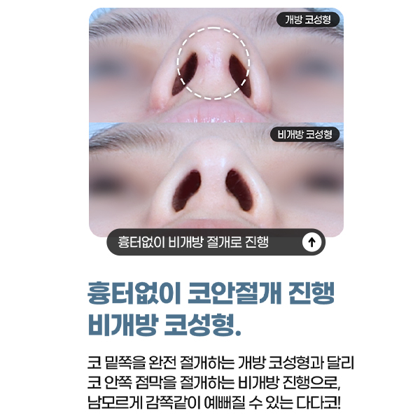 When You Want to Keep Your Image but Look Even Better: Closed Rhinoplasty Without Implants image 3