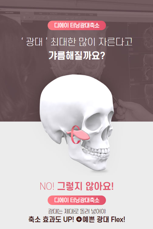 안전하지만 효과적으로, 광대축소술 관련 이미지 3
