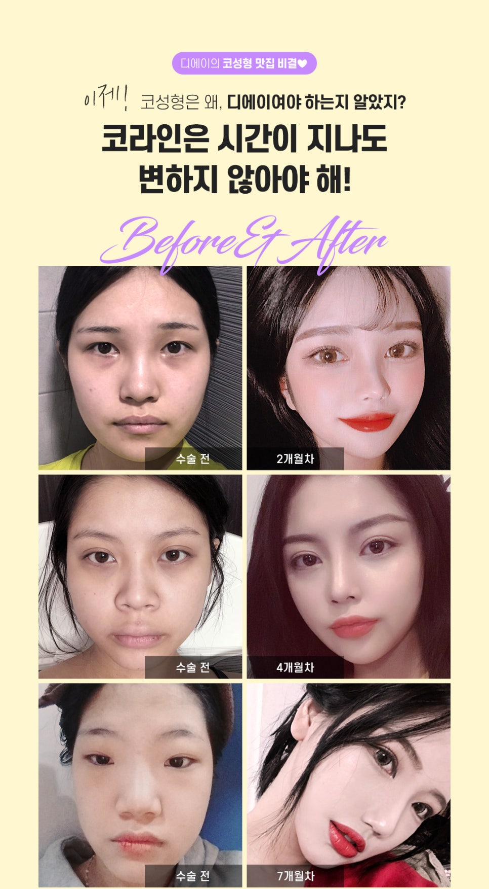 자가연골코성형 알아볼 때 주의사항 관련 이미지 6
