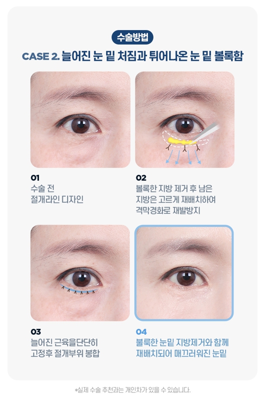 중년 눈성형, 처진 눈꺼풀의 원인에 따라 수술법이 달라집니다 관련 이미지 6