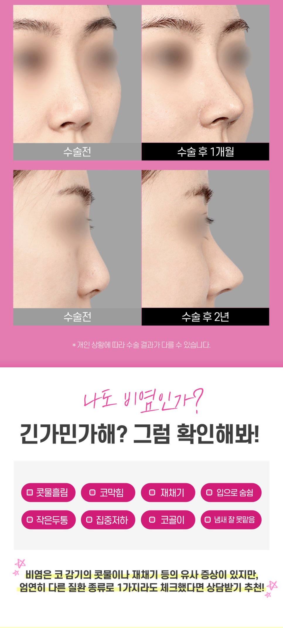비염미용코성형 안전하고 확실하게 관련 이미지 7