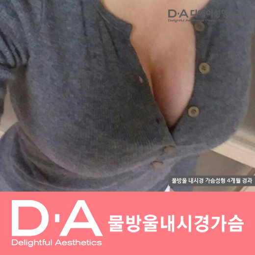 디에이성형외과의 자연스럽고 예쁜 물방울가슴성형 관련 이미지 3