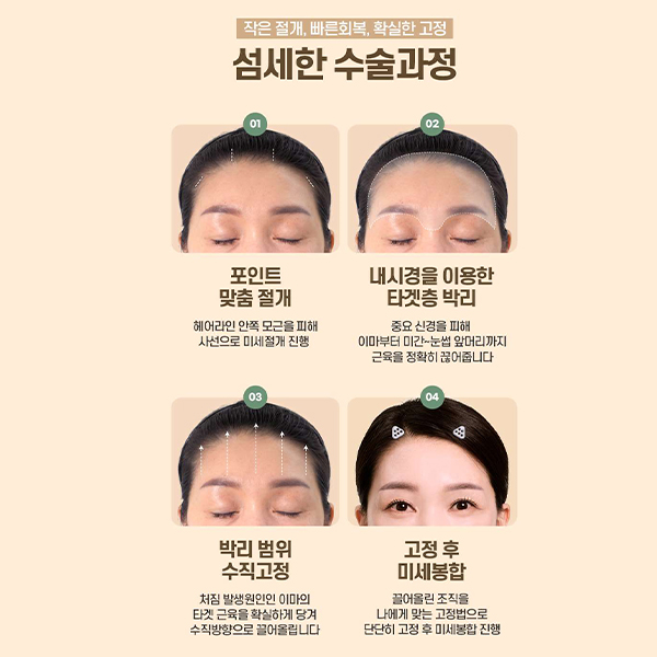 이마주름과 눈처짐을 동시에 개선, 수직 이마거상 관련 이미지 11