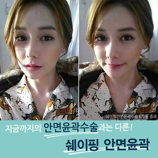최소 절제, 최상의 효과! DA성형외과 쉐이핑안면윤곽 관련 이미지 5