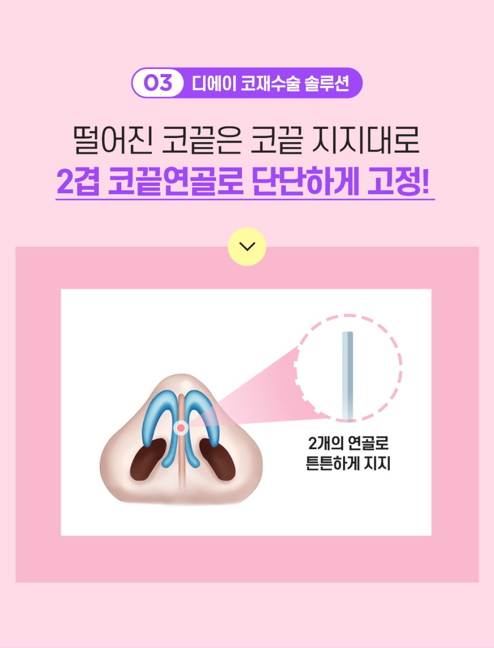 코재수술 후기 비용 신중하게 따져봐야 관련 이미지 6