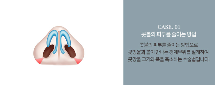 이상적인 코성형? A-Z 코유형별 방법을 알아보자 관련 이미지 11