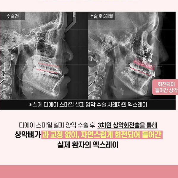 The End of Concerns About a Protruding Mouth &middot; Underbite? Key Information to Know Before Orthognathic Surgery image 6