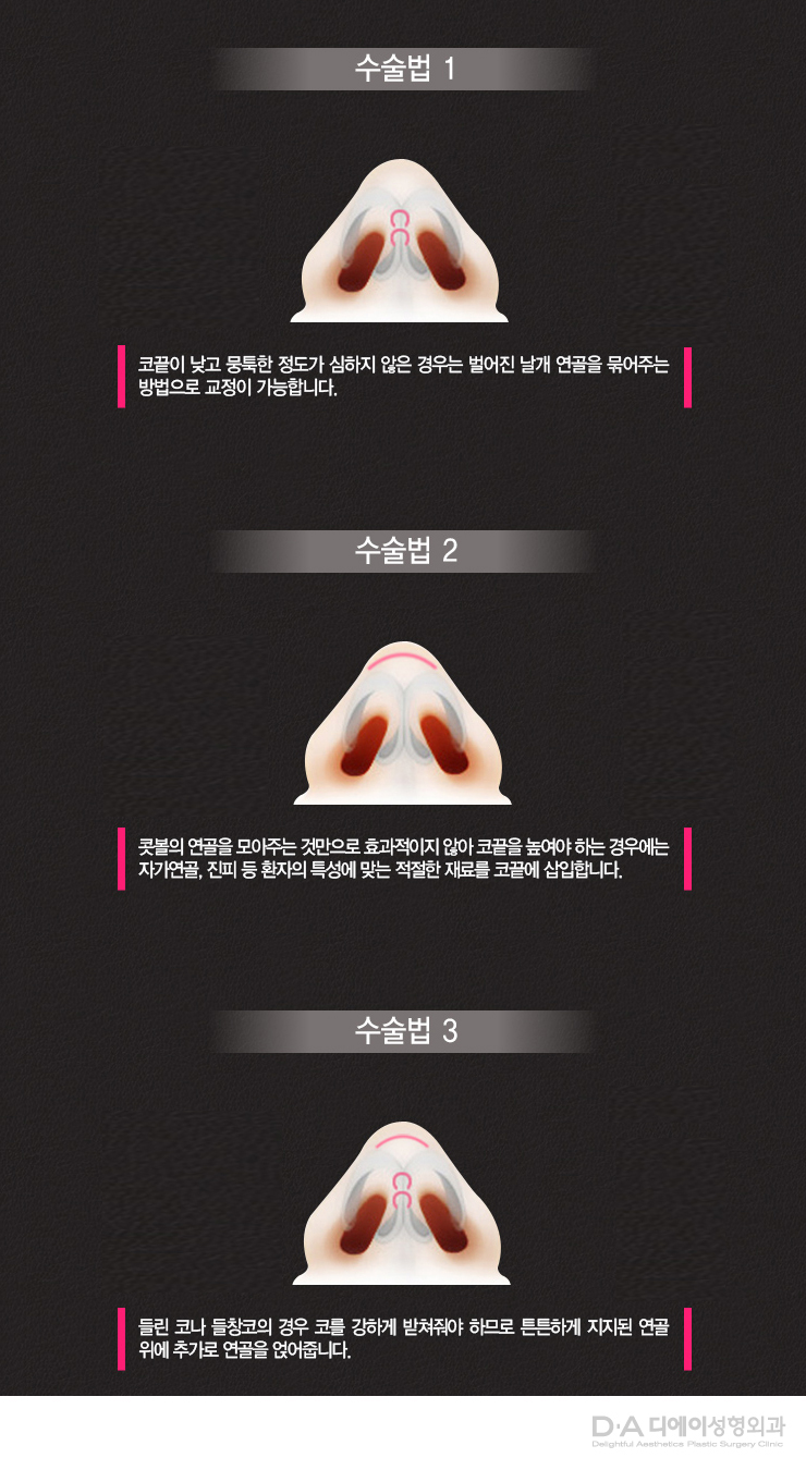 유형별 코성형의 특징과 방법 관련 이미지 24