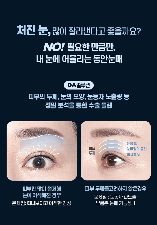 중년 눈성형, 처진 눈꺼풀의 원인에 따라 수술법이 달라집니다 관련 이미지 10