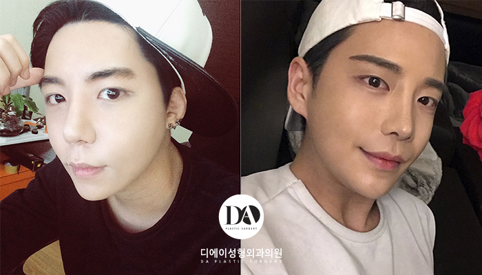 자연스러운 남자성형을 원한다면 관련 이미지 5
