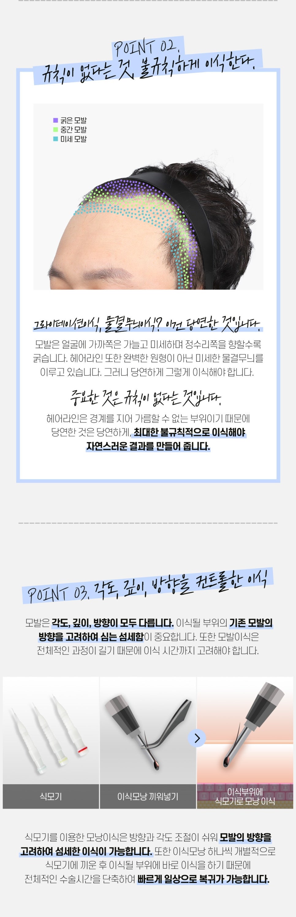 남자 헤어라인 모발이식 후기 비용 궁금하다면 관련 이미지 5