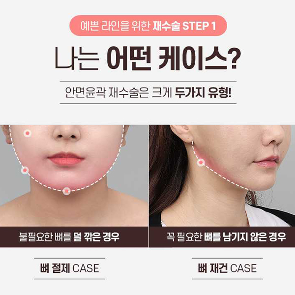 Not Satisfied After Your First Surgery? A Guide to Revision Facial Contouring Surgery image 3