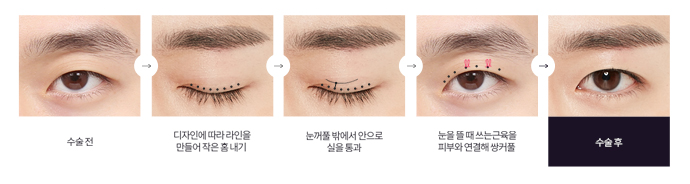 디에이성형외과 맞춤 남자눈성형 솔루션 관련 이미지 5