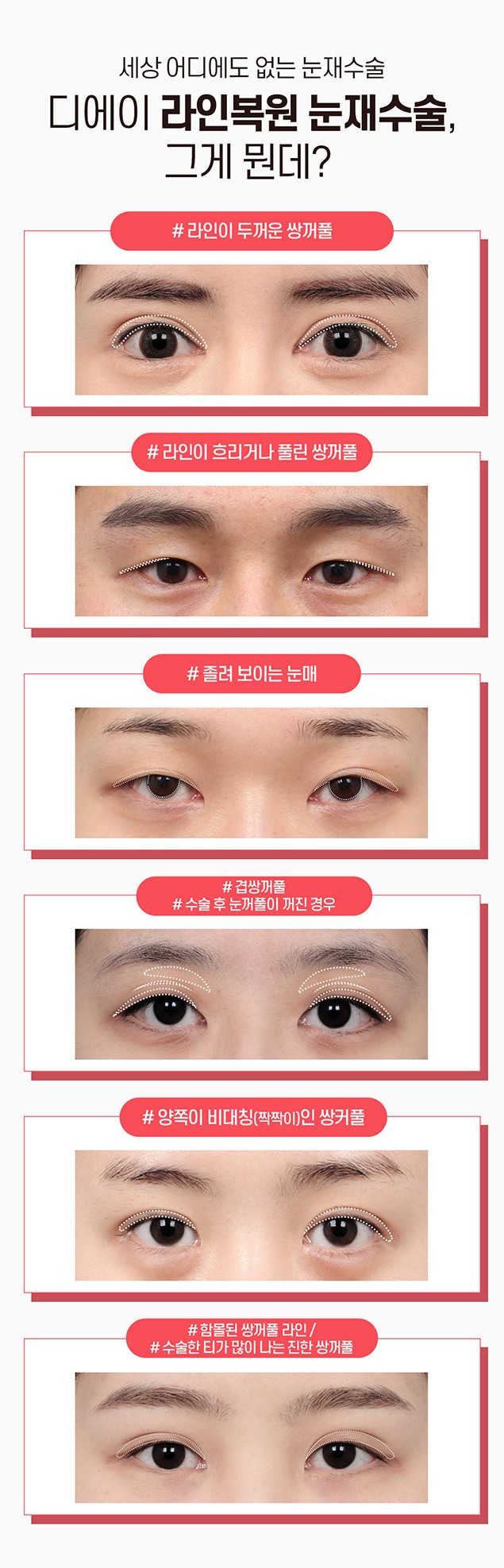 강남역 눈재수술 잘 하는 곳 관련 이미지 3