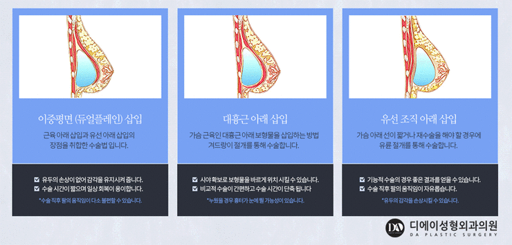 수술 전 내 가슴에 예쁜 보형물 미리 체크해보기 관련 이미지 4