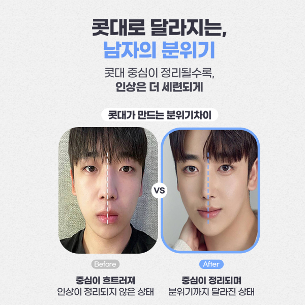 Type-Specific Male Rhinoplasty: A Natural, Refined Impression That Feels Like Your Own Nose image 6