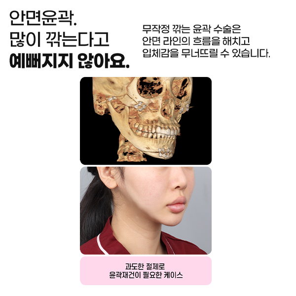 윤곽3종, 많이 깎는다고 예뻐지는 걸까? 관련 이미지 4