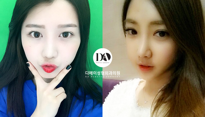 성공적인 눈성형, 관건은 눈형태에 따른 수술법 선택 관련 이미지 4