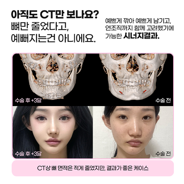 윤곽3종, 많이 깎는다고 예뻐지는 걸까? 관련 이미지 8