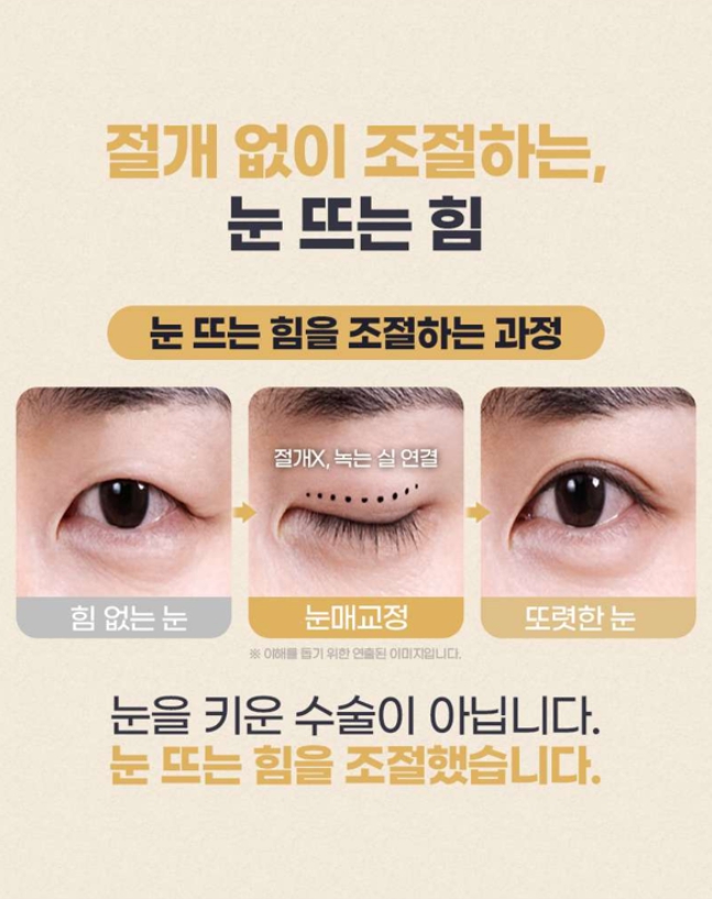 남자눈매교정, 자연스러운 남자눈성형을 위한 수술 방법과 고려사항 관련 이미지 6