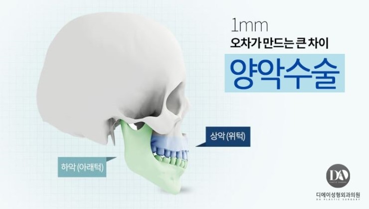 얼굴 유형에 따른 양악수술 솔루션 관련 이미지 2