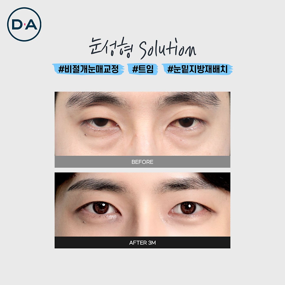 맥미남, 무엇이든물어보살 출연자는 무슨 성형 했을까? 관련 이미지 7