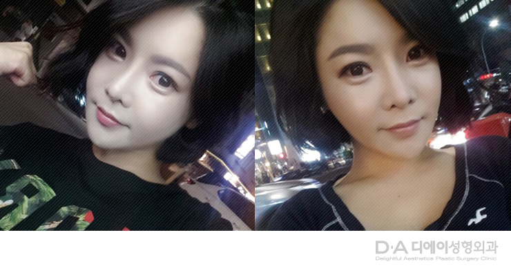 유형별 코성형의 특징과 방법 관련 이미지 19