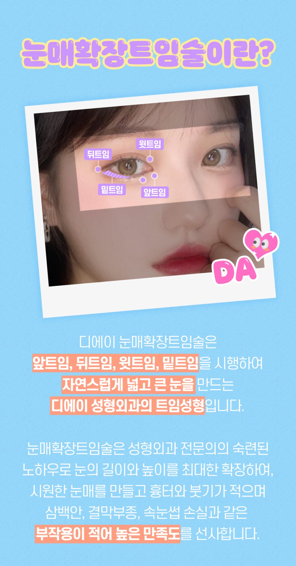 눈매확장트임으로 답답하고 사나운 눈 개선하기 관련 이미지 4