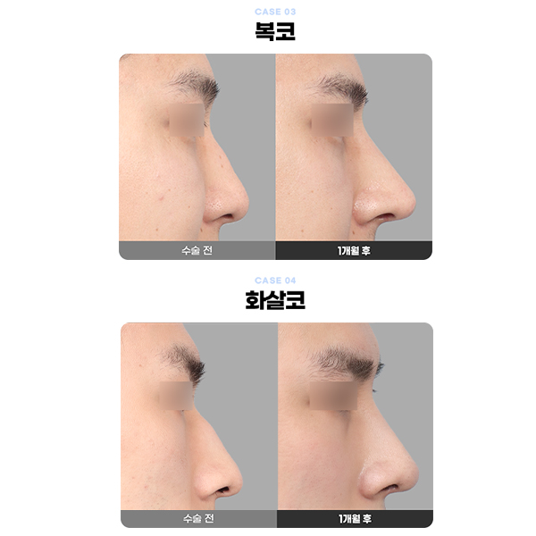 Type-Specific Male Rhinoplasty: A Natural, Refined Impression That Feels Like Your Own Nose image 11