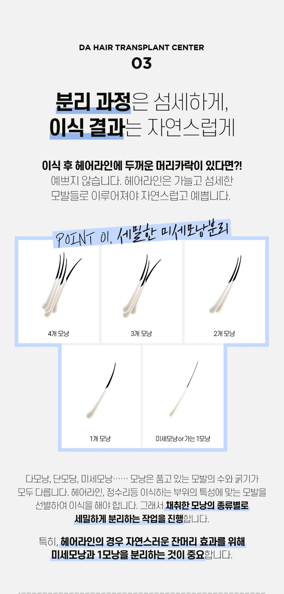 헤어라인 모발이식으로 인형외모갖기 관련 이미지 5