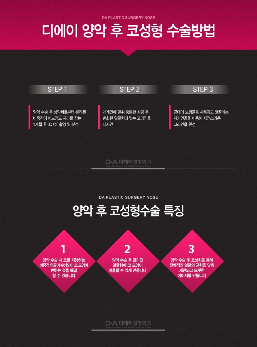양악 후 코성형 관련 이미지 4