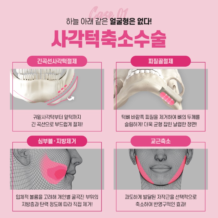 안면윤곽 수술 전 확인해야 하는 것은? 관련 이미지 6